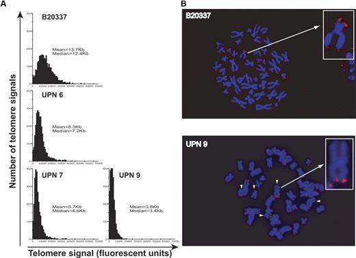 Figure 3. Telomere length analysis of DC CD34+ cells. (A) Quantitative FISH analysis of telomere length distribution and mean or median telomere length was measured in 15 individual metaphases (or 2750 individual telomeres) for day-4 cultured CD34+ cells from a control mPB sample (B20337, 39 years old), a second-generation AD DC patient (UPN 6), and 2 third-generation patients (UPNs 7 and 9). (B) Representative Q-FISH metaphase spreads (and inset enlarged chromosomes) for day-4 CD34+ cells from a control mPB sample showing detectable telomere spots for each chromosome end and from a DC sample, showing detectable signal-free ends indicated by the white arrows.