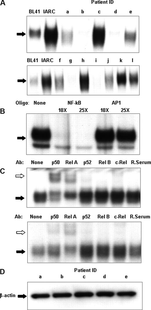 Figure 1. CLL patients show heterogeneity of NF-κB DNA binding. (A) NF-κB DNA binding activity in cell nuclear extracts was measured using electrophoretic mobility shift assays. An oligonucleotide corresponding to the consensus sequence to NF-κB was radiolabeled and incubated with 2 μg nuclear extract. The DNA-polynucleotide complex was restored by electrophoresis in a 4% native polyacrylamide gel in 0.5× Tris-borate/EDTA buffer. The gels were dried, and protein binding was visualized by autoradiography. To demonstrate specificity, a cold competitor assay was performed on 2 μg nuclear extracts of CLL patient k (B). Cold, nonradiolabeled NF-κB and a nonspecific oligonucleotide, AP1, was added at 10× and 25× the concentration of radiolabeled NF-κB and incubated for 30 minutes, before radiolabeled NF-κB incubation. (C) For qualitative analysis of NF-κB subunits, super-shift analysis was performed on NF-κB using p50, Rel A, p52, Rel B, and c-Rel antibodies and normal rabbit sera; 2 μg nuclear extracts from CLL nuclear extracts were used for these experiments. The different lanes marked, none, p50, Rel A, p52, Rel B, c-Rel, and Rab ser (pre-immune rabbit sera) represent incubation with different antibodies. They were then incubated with a radiolabeled oligonucleotide corresponding to the consensus sequence of NF-κB for 30 minutes. Ab indicates the different antibodies used; None, no antibody was incubated. White arrows indicate the antibody-protein-DNA complexes; black arrows, the protein-DNA complexes. Free DNA has been omitted. (D) Nuclear extracts from sample a through sample e were Western blotted for β-actin to assess the relative integrity of the nuclear protein extracts between samples and to confirm equal loading of nuclear proteins in the experiments.