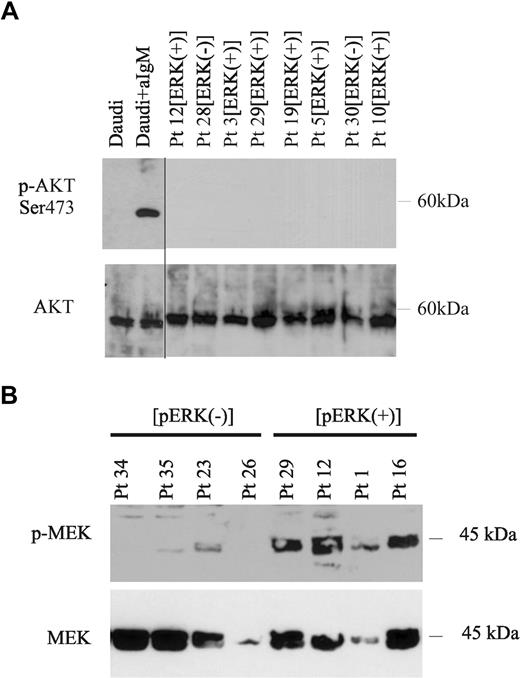 Figure 2. Constitutive activation of MEK1/2, but not of AKT in p-ERK+ CLL cells. (A) Extracts from Daudi cells either untreated or stimulated with anti-IgM, and from purified CLL cells obtained from the peripheral blood of 8 representative CLL patients previously tested positive for p-ERK1/2 (p-ERK+) or negative for p-ERK1/2 (p-ERK−), were examined for activation of AKT by immunoblot with an antibody specific for phospho-AKT (Ser473). Blots were stripped and reblotted with AKT-specific antibody (bottom panel). A vertical line has been inserted to indicate a repositioned gel lane. (B) Extracts from purified CLL cells isolated from 4 p-ERK1/2− and 4 p-ERK1/2+ CLL patients were examined for MEK phosphorylation by Western blot with an antibody specific for p-MEK1/2 (top panel). Total MEK protein levels were examined on the same blot using an antibody specific for total MEK1/2 (bottom panel).