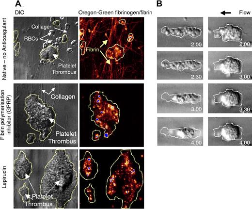 Figure 1. Fibrin-independent thrombus contraction. Human whole blood was collected in the absence of anticoagulant (Native) (A), in the presence of the fibrin polymerization inhibitor GPRP (GPRP, 280 μM) (A), or in the presence of lepirudin (800 U/mL) (A,B), then perfused through type I collagen–coated glass microslides at 1800 s−1 for up to 5 minutes. (A) To visualize fibrin formation, whole-blood perfusion was performed in the presence of Oregon green–labeled fibrinogen (20 μg/mL). DIC and fluorescence images were captured in real-time using a Leica inverted microscope (×63 magnification). Images are taken from 1 representative of 4 independent experiments. (B) Thrombus formation and consolidation during perfusion of lepirudin-anticoagulated whole-blood was recorded in real time using DIC microscopy, and snapshots of individual thrombi at the indicated time points were obtained off-line. These images are taken from 1 representative of 12 independent experiments. The original outline of the thrombus prior to contraction is highlighted by the broken line.