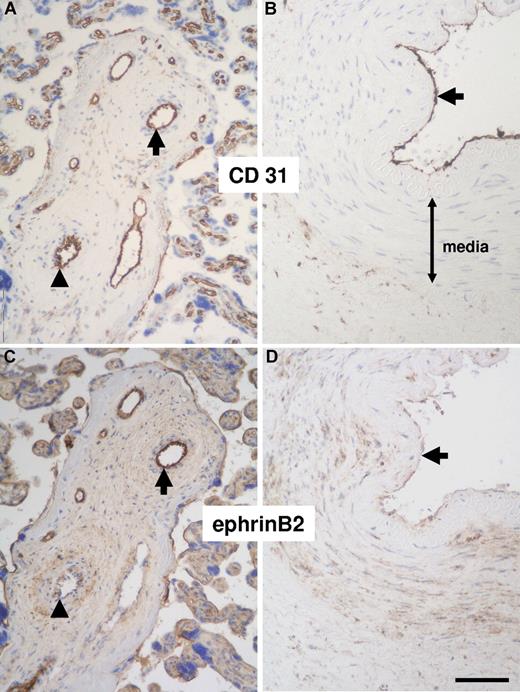 Figure 1. Immunohistochemical detection of ephrinB2 in serial sections of human arteries. Most endothelial cells from placenta arteries strongly express ephrinB2 (A,C, ⬆), whereas those in arteries with a reduced lumen-to-media ratio only weakly stain for ephrinB2 (A,C, ▴). Endothelial cells in adult coronary arteries show a markedly diminished expression of ephrinB2 (B,D, ⬆; endothelial cell staining intensity in panels C,D). Smooth muscle cells located in the media of adult coronary arteries are partially positive for ephrinB2 (D; scale bar represents 100 μm).