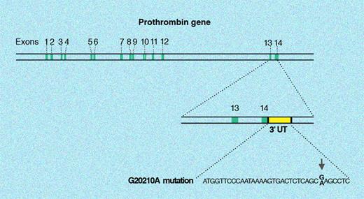Figure 6. 20210G>A mutation in the prothrombin gene. The single point G to A mutation at position 20210 affects the 3′ untranslated region of the prothrombin gene (F2). Thus the protein-coding sequence of the prothrombin gene is not affected by this mutation. Illustration by Marie Dauenheimer.