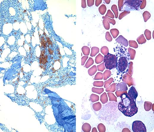 A 35-year-old man had 6 months of intense pruritis accompanying numerous small skin lesions that began in small crops on the chest and trunk and progressively enlarged. They were reddish brown with the largest lesions between 5 to 7 mm. Urticaria and dermographia (Darier sign positive) occurred with trauma. A skin biopsy showed collections of mast cells (CD117+ and CD25+). The bone marrow biopsy (see image on left) had CD117+ mast cell aggregates. The image on the right is a bone marrow aspirate with a partially degranulated mast cell. / Brown pigmented skin lesions associated with mast cells are known as urticaria pigmentosa. In systemic mastocytosis, neoplastic mast cells also accumulate in various internal organs with often devastating consequences. Recently, it has been shown that activating c-Kit mutations can be involved in the pathophysiology of the disorder. Tyrosine kinase inhibitors are a therapeutic consideration. However, the most common c-Kit activating mutation, D816V, is not sensitive to imatinib. Other tyrosine kinase inhibitors and monoclonal antibodies are currently being tested in clinical trials for imatinib-resistant mastocytosis patients. / This patient was diagnosed with systemic mastocytosis with urticaria pigmentosa. Imatinib was administered and, within a few months, there was considerable improvement in the pruritis and appearance of the skin lesions.