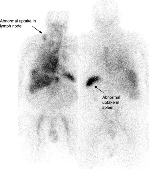 Figure 3. 123I-labeled SAP scan from a patient with IgM-associated AL amyloidosis showing uptake of the radiotracer within the involved right cervical lymph node (arrow) in addition to some splenic uptake. There is a normal blood pool tracer signal from the heart and liver.
