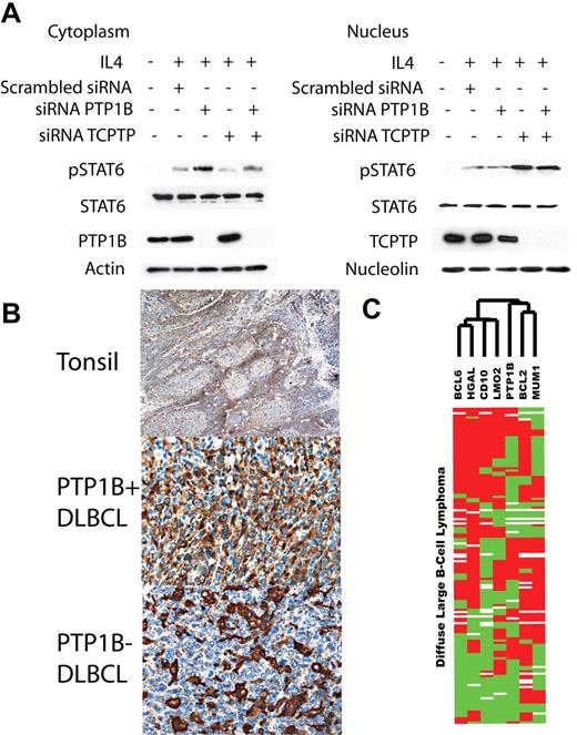 Figure 8. Coordinated regulation of STAT6 by PTP1B and TCPTP and PTP1B expression in DLBCL. (A) HeLa cells were transfected with either SMART pool siRNA for PTP1B, TCPTP, or scrambled control (200 pmol). At 72 hours after transfection, the cells were stimulated with IL-4 (100 U/mL) for 15 minutes. Cytoplasmic and nuclear lysates were extracted and blotted for tyrosine-phosphorylated STAT6 (pSTAT6), STAT6, PTP1B, TCPTP, actin, and nucleolin. (B) Immunohistochemical staining for PTP1B in tonsils and DLBCL. Low magnification image of normal tonsil sections shows PTP1B-specific staining mainly outside germinal centers (original magnification ×40); PTP1B staining is localized to the cytoplasm. Also demonstrated are representative examples of PTP1B immunostaining in DLBCL (original magnification ×400). Images of immunohistologic staining were acquired using a Nikon Eclipse E400 microscope (Nikon, Tokyo, Japan) and a Nikon DS-L1 digital camera. (C) Hierarchical cluster analysis of immunohistologic data. The expression patterns of 7 proteins (LMO2, HGAL, CD10, BCL6, MUM1/IRF4 (MUM1), BCL2, and PTP1B) in 80 cases of DLBCL are shown. Positive staining is indicated in red, lack of staining in green, and uninformative data in white. PTP1B protein expression is clustered on the same branch of the dendrogram as nongerminal-center proteins MUM1 and BCL2 and away from germinal-center proteins HGAL, BCL6, LMO2, and CD10.