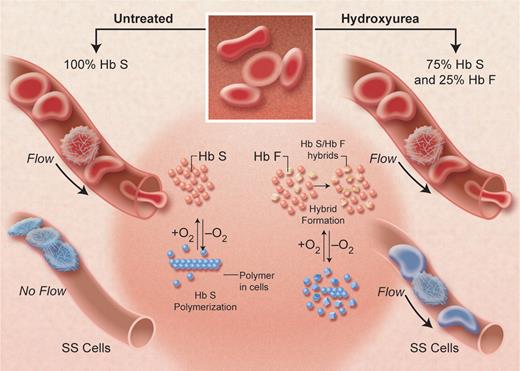 Figure 7. A diagram of the postulated effect of hydroxyurea in inhibiting hemoglobin S-polymerization, by increasing hemoglobin F levels (shown as 25%) in each sickle erythrocyte and thus decreasing the degree of microvascular obstruction at any oxygen level. The sparing effect of hemoglobin F, greater than that of hemoglobin A, occurs because the mixed hybrid α2βSγ that forms inside the red cell does not enter the polymer phase. Adapted from Schechter and Rodgers (N Engl J Med. 1995; 334:333-335), with permission. Illustration by Alice Y. Chen.