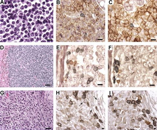 Figure 2. Lymphoma and retroperitoneal fibromatosis (RF) in RRV-infected RMs. (A) Hematoxylin and eosin stain of lymphoma isolated at biopsy from the breast of animal 19185 (original magnification ×630). (B) Combined in situ hybridization of lymphoma with RRV cosmid probe (purple) and immunohistochemistry with mouse anti-CD20 (brown) and anti-CD3+ (gray) demonstrates that RRV is present in CD20+ cells comprising the lymphoma (original magnification ×630). (C) Same as panel B, except cosmid vector control replaces the RRV cosmid probe. (D) Hematoxylin and eosin stain of lymphoma isolated from liver of animal 19286 during necropsy (original magnification ×200). (E) Same as panel B, except RRV cosmid probe detected by immunofluorescence (purple) with no evidence of CD20 staining. (F) Similar to panel C; this is the control for panel E. (G) Hematoxylin and eosin stain of RF attached to the stomach of animal 18483 (original magnification ×400). (H) Combined in situ hybridization with RRV cosmid probe (purple) and immunohistochemistry with anti-CD20 (brown) and anti-CD3 (gray) shows that RRV is not present in the CD20+ or CD3+ cells (original magnification ×1000). Arrows point to RRV-positive cells that have spindle-like morphology. (I) Identical to panel H, except vector control replaces the RRV cosmid (original magnification ×630).