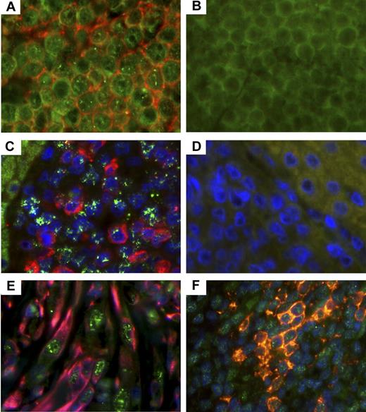 Figure 4. Detection of vIL-6 in RRV-associated lymphomas, RF, and MCD. (A) Lymphoma from RM 19185 was stained with murine monoclonal antibodies specific for RRV vIL-6 and CD20. (C) Lymphoma from animal 19286 was stained with murine monoclonal antibodies specific for RRV vIL-6 and goat antihuman IgM, and nuclei. (B,D) Isotype controls (original magnification ×630). (A) vIL-6 (green) and CD20 (red). (B) Isotype controls for vIL-6 and CD20. (C) vIL-6 (green) and IgM (red), and nuclei (blue). (D) Isotype controls for vIL-6 and IgM. (E) RF from animal 18483 was stained for vIL-6 (green), vimentin (red), and nuclei (blue). Original magnification ×630. (F) MCD lesion from animal 19455 was stained for vIL-6 (green), CD20 (red), and nuclei (blue). Original magnification ×630.