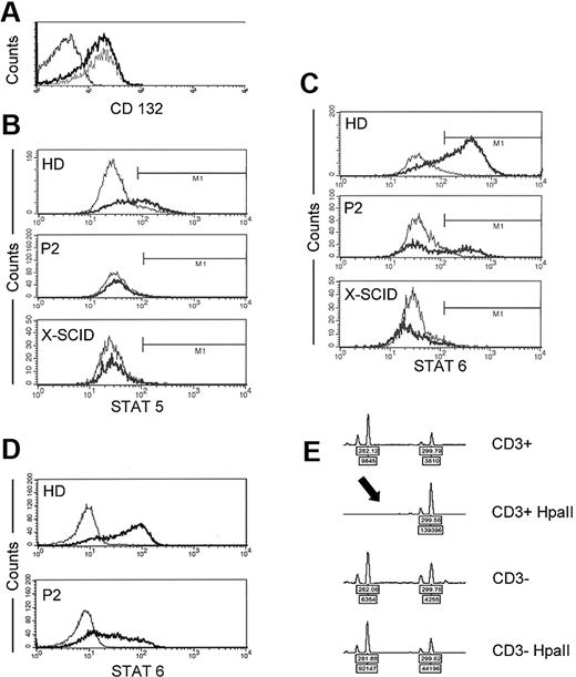 Figure 2. Functional consequences of the IL2RG mutation. (A) Expression of CD132 on B cells of the patient (gray line) and a healthy control (bold line; light line indicates isotype control). (B) STAT-5 phosphorylation after IL-2 stimulation in EBV-transformed B cells from a healthy donor (top panel), P2 (middle panel), and an X-SCID patient with a c.545G>A (Cys182Tyr) mutation. The gray lines represent isotype controls. (C) STAT-6 phosphorylation after IL-4 stimulation in EBV-transformed B cells. (D) STAT-6 phosphorylation after IL-4 stimulation of fresh B cells from a healthy donor (top) and P2 (bottom). (E) X-inactivation analysis of DNA obtained from sorted maternal T cells or T cell–depleted PBMCs. The CGG repeat within the FMR1 gene was amplified from undigested DNA (first and third panels) and after digestion with the methylation-sensitive restriction enzyme HpaII (second and fourth panels). Note the absence of a second PCR product in the second panel indicating completely skewed X inactivation.