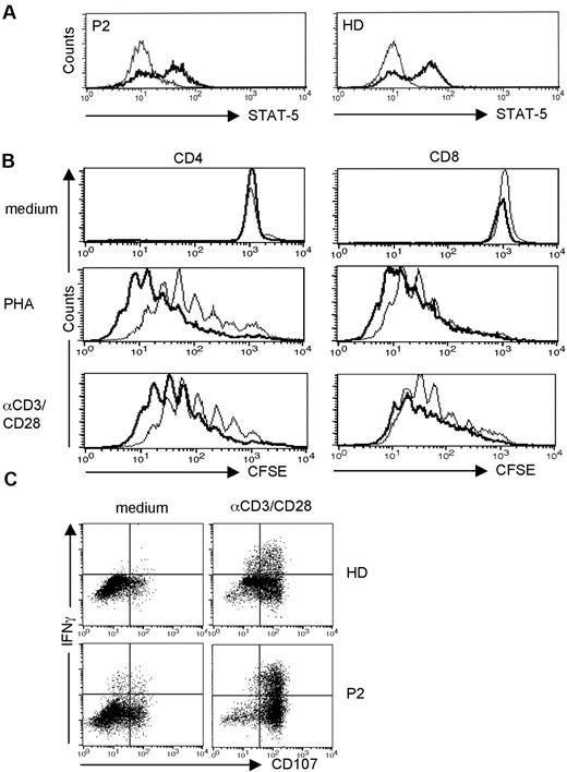 Figure 4. Functional T-cell analysis. (A) STAT-5 phosphorylation after IL-2 stimulation in CD3+ T cells from a healthy donor (right panel) and P2 (left panel). The light lines represent isotype controls. (B) Proliferation of CD4+ (left panel) and CD8+ (right panel) T cells as determined by CFSE dilution after incubation of a 1:1 mixture of sorted CD3+ T cells and CD3-depleted PBMCs with medium (top panels), PHA (middle panels), or anti-CD3/anti-CD28 beads (bottom panels) for 5 days. The graphs show overlay histograms of the data obtained from the patient (bold line) and a healthy donor (light line). (C) Degranulation of activated T cells. Surface expression of the lysosomal marker protein CD107 (indicating T-cell degranulation) and intracellular expression of IFN-γ were determined on PHA blasts that were placed either in medium (left panels) or in medium containing anti-CD3/anti-CD28 beads for 5 hours. The dot plots are gated on CD3+ CD8+ T cells.
