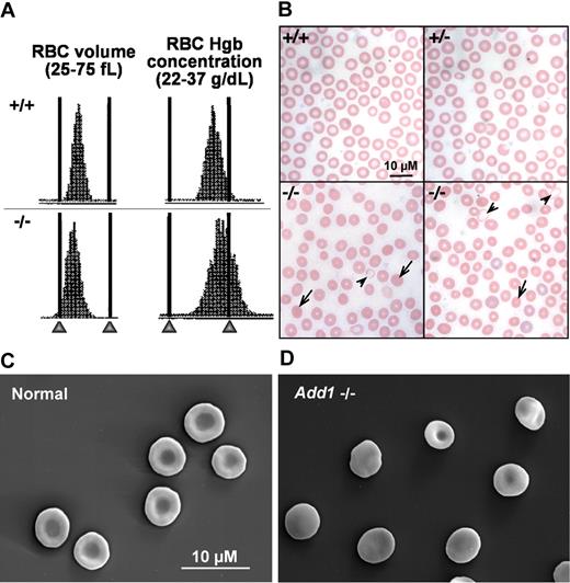 Figure 4. Adducin-null RBCs show features of HS. (A) RBC volume and hemoglobin concentration histograms indicate a population of small (left-shifted volume histogram) and dehydrated (right-shifted hemoglobin concentration histogram) in α-adducin–null (−/−, bottom) versus wild-type (+/+, top) RBCs. (B) Peripheral blood smears reveal a significant population of spherocytes () with a small population of severely hypochromic cells (). +/+ indicates wild-type; +/−, heterozygotes; and −/−, homozygous null. Bar represents 10 μM. (C) Biconcave RBCs from a normal littermate and (D) an α-adducin–null mouse showing significant spherocytosis. Bar represents 10 μM.