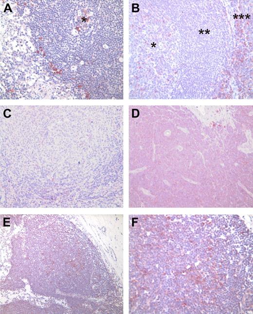 Figure 2. TOSO protein expression in lymph nodes from healthy donors, patients with follicular lymphoma, and patients with CLL. (A) Inguinal lymph node with small, regressive germinal center (*). Single TOSO-positive cells are seen in the germinal center as well as within the sinus. Cytomorphologically, these cells are assigned to plasmocytic cells. (B) Cervical lymph node with prominent germinal center (*), mantle zone (**), and small marginal zone (***). Single TOSO-positive plasmocytoid cells within the germinal center; ample TOSO positive cells in the marginal zone. (C) Lymph node infiltrated by a low-grade follicular lymphoma. Within the neoplastic follicle, no TOSO expression is visible. (D-F) Two examples of lymph node infiltration by CLL. (D) TOSO expression is seen as a distinct staining in almost all neoplastic B cells. (E) Distinct clusters of strongly positive cells are visible within the infiltrate. These clusters are not necessarily limited to proliferation centers within the infiltrates. (F) Magnification of panel E. (A-E) Magnification ×200; (F) magnification ×400. Immunohistochemistry was performed using 6B10 antibody on paraffin-embedded sections.