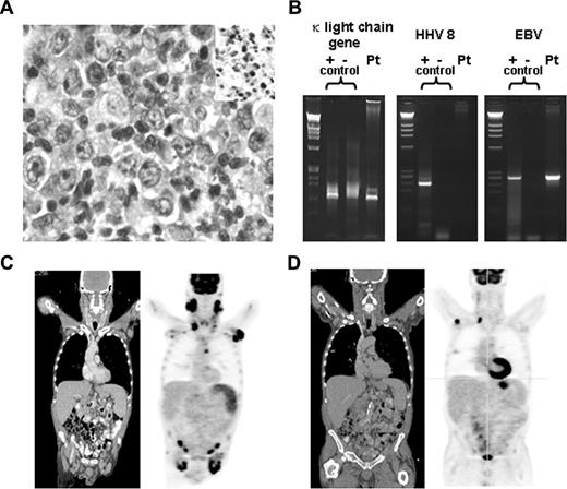Figure 1. Pathologic and radiologic data. (A) High-power magnification of right cervical lymph node biopsy. Micrographs were acquired with an Olympus BX41 microscope (Tokyo, Japan) using a 40×/0.75 objective on cells stained with hematoxylin and eosin and in situ EBV staining (insert). Images were captured with a color mosaic camera (model no. 11.2) using Advanced Spot software, version 4.0.9 (Diagnostic Instruments, Sterling Heights, MI). (B) PCR for κ light chain gene rearrangement, HHV8 and EBV; positive controls are on the left, negative controls in the middle, and patient sample on the right for each set of PCRs. (C) Coronal sections of CT (left) and PET (right) scan before initiation of HAART. (D) Coronal sections of CT (left) and PET (right) scan after initiation of HAART and before chemotherapy.