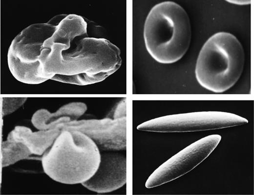 Figure 1. Multilobular reticulocyte (top left panel), the precursor of the mature discoid red cell (top right panel). A red cell traversing from the splenic cord to splenic sinus (bottom left panel). Note the marked deformation the cell undergoes during its passage through the narrow endothelial slit separating the cord from the sinus. Ellipsoidal cells generated in vitro by flow-induced deformation in vitro of discoid cells (bottom right panel).