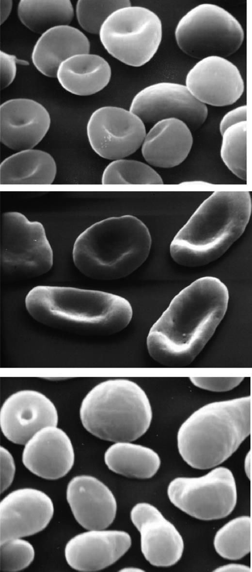 Figure 4. Red cell morphology. Hereditary spherocytosis (HS; top panel); nonhemolytic hereditary elliptocytosis (HE; middle panel); elliptocytes, poikilocytes, and fragmented red cells in hemolytic HE (bottom panel).