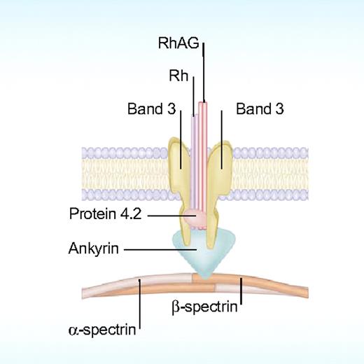 Figure 5. Membrane defects in HS affect the “vertical” interactions anchoring the membrane skeleton to the lipid bilayer. Deficiency in any one of the protein components (band 3, RhAG, ankyrin, protein 4.2, or spectrin) involved in the anchoring process leads to HS. Illustration by Paulette Dennis.