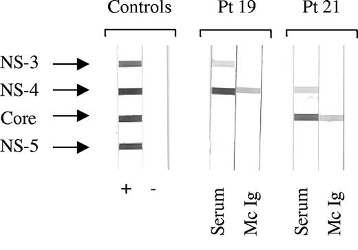 Figure 1. Determination of HCV protein specificity by recombinant immunoblot assay. For each patient (Pt), serum (S) and purified monoclonal Ig (Mc Ig) were incubated with blots carrying recombinant HCV nonstructural (NS) and core proteins. Serum and Mc Ig protein concentration was 4 μg/blot. Depending on the patient's Mc Ig, the horseradish peroxidase conjugates used were anti-γ, anti-α, or anti-μ chains. Typical results are shown for Mc Ig specific for HCV NS-4 protein (Pt 19) and Mc Ig specific for HCV core protein (Pt 21).