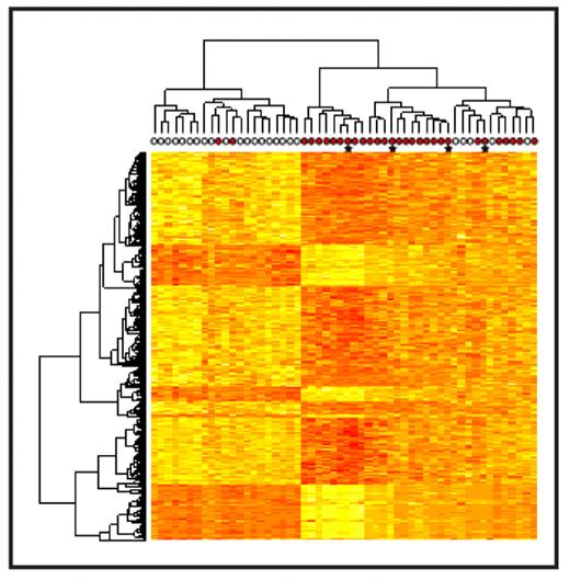 Figure 1. Gene expression signature of top differentially expressed genes in Down syndrome (DS) versus non-Down syndrome acute lymphoblastic leukemia (ALL).