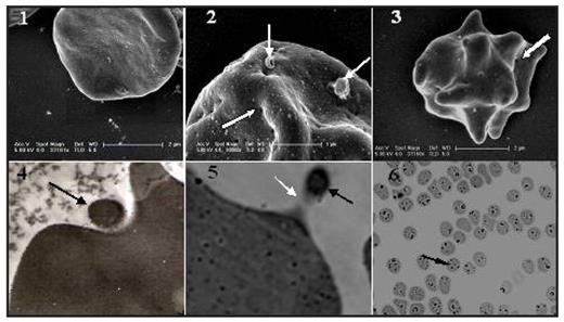 Fig. 1:. Field emission scanning electron microscope to diagnose the Eperythrozoonsis. The mildly (Fig. 1--1) and severely (Fig. 1–2) infected RBCs. Erythrocyte in picture 1 (Fig. 1--1) had not been deformed but cells in (Fig. 1–2) and (Fig. 1–3) were badly misshapen with some holes on its surface. Transmission electron microscope showed the location of these organisms in erythrocyte depressions (Fig. 1–4) and fibril of these organisms connected with RBC was also observed when these organisms disassociated from erythrocyte (Fig. 1–5). Blood smear stained by Wright-Giemsa mixture demonstrated severe bacteremia (Fig. 1–6).
