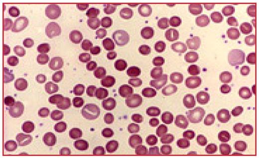 Figure 1:. Peripheral Blood smear showing anisopoikilocytosis & spherocytosis.
