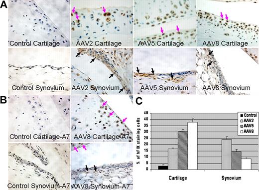 Figure 3. Immunohistochemical staining (IHC) of factor IX. Hemostatically normal C57BL/6 mice received IA injection of 2.5 × 109 vg AAV2, AAV5, or AAV8 expressing hFIX into the left knee joint capsule. Four weeks later, the AAV-treated knee and untreated control knee were collected, and immunostaining performed for hFIX using polyclonal anti-FIX (A) or using monoclonal antifactor IX A-7, specific for γ-carboxylated factor IX (B). HRP stain appears brown in FIX-expressing cells. Hematoxylin was added as counterstain in all images. (A) Control knee has primary (antifactor IX) antibody omitted and subsequent staining steps performed, demonstrating no background HRP (brown stain). Panels labeled AAV2, 5, and 8 cartilage demonstrate HRP staining cells within ssAAV2, 5, and 8-CBA-hFIX-transduced cartilage. Panels labeled AAV2, AAV5, or AAV8 synovium demonstrate HRP staining cells within ssAAV2, 5, and 8-CBA-hFIX-transduced synovium. (B) Immunostaining performed using monoclonal anti-FIX A-7 antibody. Control (negative) has primary A-7 antibody omitted and subsequent staining steps performed. Representative images of ssAAV8-CBA-hFIX transduced cartilage and ssAAV8-CBA-hFIX transduced synovium are shown after A7-HRP labeling. Pink arrows represent individual factor IX-staining chondrocytes within cartilage; black arrows, transduced FLS within the synovial lining (original magnification ×400). N = 3 to 5 animals per treatment group. (C) Quantitative analysis of cells in cartilage and synovium expressing hFIX after AAV2-, AAV5-, or AAV8-CBA-hFIX transduction. Data are represented as percentage of hFIX positive staining cells; error bars represent SD (n ≥ 4 animals/group).