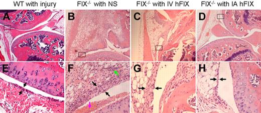 Figure 4. Representative histopathologic findings at 2 weeks after joint bleeding challenge. (A,E) Wild-type (WT, hemostatically normal) mouse knee joint after needle puncture and IA NS injection; joint space is well maintained with normal 3- or 4-cell layer synovial lining and no synovial hypervascularity. (B,F) FIX −/− mouse joint after needle puncture and IA NS injection; gross blood is seen in the joint space (pink arrow), which is narrowed by synovial proliferation (black arrow) with areas of discoloration resulting from hemosiderin staining (green arrow). (C,G) FIX −/− mouse joint after IV recombinant hFIX 50 IU/kg followed by needle puncture and IA NS injection; hypervascularity (low-power view) and synovial thickening (> 8-10 cell layers, black arrow, high-power view) are present. (D,H) FIX −/− mouse joint after needle puncture with coincident IA injection of hFIX 25 IU/kg; joint space is well maintained with thin synovial lining (black arrow) and smooth cartilage. Top panel, original magnification ×40; bottom panel, original magnification ×200.