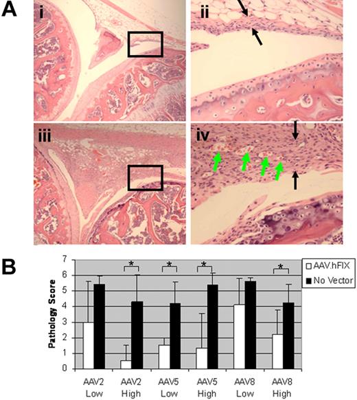 Figure 5. IA AAV-FIX expression within the joint protects from hemorrhage-induced synovitis. FIX −/− mice received AAV in left hind limb joint and normal saline in right hind limb joint under hemostatic coverage with IV FIX. Bilateral hind limb joints received puncture injury at 4 weeks after gene delivery; 2 weeks after injury, joints were collected. (A) Top panels: Representative pathologic changes of minimal synovitis at 2 weeks after puncture injury of knee receiving prior treatment with ssAAV5-CBA-hFIX (2.5 × 109 vg). Left, original magnification ×40; right (area of detail from left figure, indicated by box), original magnification ×200. Bottom panels: Injured untreated knee demonstrates changes of hemarthropathy, including synovial proliferation narrowing the joint space, synovial thickening (black arrows), foci of hypervascularity (green arrows), and synovial overgrowth of the tibial articular surface. Left, original magnification ×40; right (area of detail from left figure, indicated by box), original magnification ×200. (B) Histopathologic grading of mice treated with AAV-hFIX IA delivery and comparison with pathology score of contralateral injured untreated knee (“No vector” control). High dose, 1010 particles/animal; low dose, 2.5 × 109 particles/animal (n = 4 animals/group). *P < .05