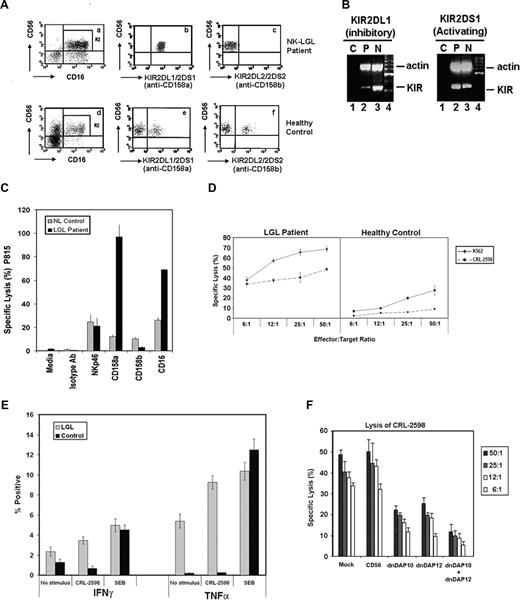 Figure 1. Phenotype analysis and function of NK receptors in LGL patient. All experiments were performed in vitro using cells collected before treatment with tipifarnib. (A) The phenotype was determined by flow cytometry and dot plots are shown on CD56+/CD16+/CD3− NK-cells (R2) from the NK-LGL patient (a) and healthy control (d). The reactivity of NK cells to anti-CD158a (KIR2DS1/KIR2DL1) and anti-CD158b (KIR2DS2/KIR2DL2/KIR2DL3) antibody in the patient (b and c, respectively) compared with a healthy donor (e and f, respectively). (B) RT-PCR of this patient (P) and a healthy control (N) for KIR2DS1 and KIR2DL1. Control (Bl, blank) is shown containing no template. (C) NK-cells (effector cells) from the LGL patient (■) and healthy donor () were used for reverse ADCC experiments. Effector cells were exposed to medium (negative control), isotype antibody control, anti-NKp46 antibody, anti-CD158a antibody, anti-CD158b antibody, and anti-CD16 antibody before interaction with the NK-resistant (FcR)–expressing P815 multiple myeloma cell line at an effector-to-target cell (E:T) ratio of 50:1. (D) NK cells from a healthy control or the LGL patient were used at 6:1, 12:1, 25:1, and 50:1 E:T ratios using both K562 (NK sensitive target, —) and CRL-2598 (endothelial cell line, ----) cells as the target. (E) NK cells were cultured in medium (no stimulation), admixed with CRL-2598 at an E:T cell ratio of 1:1, or cultured with staphylococcal enterotoxin B (SEB) as a positive control for IFNγ and TNFα release. Intracellular cytokine flow cytometry was used to detect these cytokines in the NK cells from the LGL patient (■) and a healthy donor (). (F) dnDAP10 and dnDAP12 viruses were engineered to carry a single Y→A mutation at the location of Y75A or a double mutation at both Y64A and Y75A within the YxxM activating ITAM motif; shown previously to be an effective inhibitor of endogenous ITAM signaling by other T-cell receptors and NK receptors.16–19 NK cells from the LGL leukemia patient were treated under mock conditions, infected with recombinant CD56 vaccinia virus (CD56, control), dnDAP10 alone, dnDAP12 alone, or a combination of dnDAP10 plus dnDAP12 recombinant vaccinia viruses. These groups of effector cells were admixed at 6:1, 12:1, 25:1, and 50:1 E:T ratios with the CRL-2598 target cells. Cells were examined for cytotoxicity in 5-hour 51-Cr release assays (E:T ratio, 1:1).