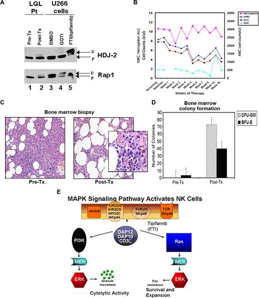 Figure 2. Results of treatment with tipifarnib. (A) Western blot for HDJ-2 and Rap1 protein prenylation, which are substrates for FTase and geranylgeranyltransferase enzymes, respectively. P = processed (farnesylated) HDJ-2 and (geranylgeranylated) Rap1. U = unprocessed (nonfarnesylated HDJ-2 and nongeranylgeranylated Rap1). Pretreatment (pre-tx; lane 1) and posttreatment (post-tx; lane 2) PBMCs were collected from the patient treated in vivo with tipifarnib for 4 months. U266 multiple myeloma cells cultured in vitro with DMSO (C, lane 3) served as control for processed HDJ-2 and Rap1 proteins. Treatment of U266 cells with the selective GGTase I inhibitor, GGTI-2431 50 μM (G lane 4) and FTI-2153 20 μM (F lane 5) served as controls for migration of the unprocessed proteins. (B) CBC results obtained during the active treatment phase of a clinical trial. Hemaglobin, white blood cell count (WBC), absolute lymphocyte count (ALC), and absolute neutrophil count (ANC) are shown. (C) Results of bone marrow biopsies performed at baseline (pretreatment) and after 4 courses of tipifarnib (posttreatment). Insert shows higher magnification of a cluster of large early erythroid precursors with nucleoli apparent after treatment. (D) Bone marrow aspirates were obtained at the time of biopsy and analyzed for colony formation in vitro and the number of CFU-GM and BFU-E are shown. Bars represent the mean number of colonies in 3 separate plates and the error in these measures is shown. (E) Diagram of the NKR signaling cascade. Activating NKR such as NKG2D, KIR2DS, KIR3DS, NKG2C, NKp44, NKp46, FcRγIII (CD16), TCR, and NKp30 act through 3 adaptor proteins either in a homodimeric or heterodimeric form (DAP12, DAP10, and CD3ζ). These signals lead to Ras and PI3K activation, granule redistribution and cytolysis or resistance to Fas-mediated apoptosis, survival, and expansion. Blockage of this pathway with the farnesyl-transferase inhibitor (FTI) tipifarnib or inhibitors of the adaptor molecules prevents the downstream activation of these effector functions.