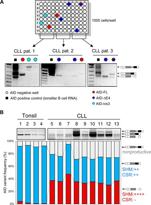 Figure 7. Expression of AID-splicing variants in CLL B cells. (A) Purified CLL B cells from 3 patients were limiting diluted into 96-well PCR plates at the densities of 1000 cells/well (depicted in top panels). The wells filled with various colors indicate where AID was positively detected, and the color codes show the identities of the AID PCR products. (Bottom panels) DNA gel images showing the amplified AID variants from those PCR-positive wells. Data shown are representative of a total of 6 B-CLL patients studied in this manner. (B) Overexpression of AID-splicing variants in CLL B cells. (Top panel) A composite gel image of AID RT-PCR; while the bar chart (bottom panel) is the quantitation of the same image by densitometry. The Ig VH genes in CLL B cells shown in lanes 5, 6, 11, and 13 were mutated and those shown in lanes 7 to 10 and 12 were unmutated.