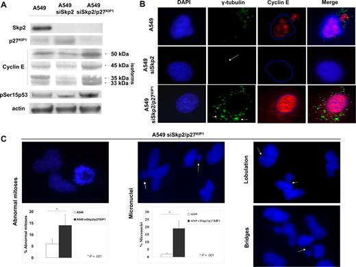Figure 1. Effect of Skp2 silencing alone or in combination with p27KIP1 in A549 carcinoma cell line. (A) Western blot analysis of Skp2, p27KIP1, cyclin E and low-molecular-weight isoforms, Ser15 phosphorylated p53 levels in A549 mock, siSkp2-, and siSkp2/p27KIP1-treated cells. (B) Impact of deregulated cyclin E expression on centrosome status after Skp2 and Skp2/p27KIP1 silencing in A549 cells. Immunofluorescence analysis (Texas Red = cyclin E, Oregon Green = γ-tubulin) and counterstaining with DAPI. A549 mock cells demonstrate moderate nuclear staining of cyclin E accompanied by centrosome amplification (top panel, magnification ×600). A549 siSkp2 cells display normal centrosomal profile (arrow) and suppression of cyclin E expression (middle panel). A549 siSkp2/p27KIP1 cells showed increased, cyclin E levels (accumulation of both nuclear and cytoplasmic isoforms) and centrosome aggregates (arrows; bottom panel). (C) Abnormal mitoses, micronuclei, nuclear lobulation, and nucleoplasmic bridges in A549 siSkp2/p27KIP1 cells. Cells were counterstained with DAPI. Histograms depict percentages of abnormal mitoses (P = .001, ANOVA) and micronuclei (P < .001, ANOVA) in A549 mock and A549 siSkp2/p27KIP1-treated cells. Images in panels B and C were viewed through a Zeiss Axiolab microscope with 63 times 0.80, Zeiss Achroplan lens (both Carl Zeiss, AntiSel). Cell spreads were mounted in Fluoromount G. Texas Red was used to detect cyclin E, Oregon Green to detect γ-tubulin, and DAPI as a counterstain (Invitrogen, AntiSel). Images were photographed with a SenSys camera (Photometrics, Tucson, AZ) and processed with SmartCapture VP software version 1.4 (Digital Scientific, Cambridge, United Kingdom).