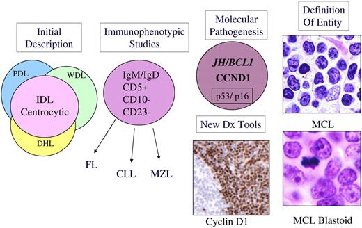 Figure 1. Schematic diagram illustrating evolution of the entity MCL. MCL was recognized in Kiel classification and modified Rappaport classification as centrocytic lymphoma and lymphocytic lymphoma of intermediate differentiation (IDL), respectively.6 Precise criteria for the distinction from other morphologically similar lymphomas were lacking. The recognition of a characteristic immunophenotype (CD5+, CD23−, CD10−, monoclonal B cell) helped better define the entity. The identification of the t(11;14) resulting in CCNDI/IGH translocation in virtually all cases of MCL led to the use of cyclin D1 detection by immunohistochemistry for diagnosis. In addition, secondary genetic events such as p53 and p16 deletion/mutation were identified in high-grade variants of MCL, which had been recognized histologically as the “blastoid” subtype. The data derived from immunophenotypic and genetic studies are integrated, culminating in our current definition of the disease. PDL indicates poorly differentiated lymphocytic; WDL, well-differentiated lymphocytic; DHL, diffuse histiocytic lymphoma; and MZL, marginal zone lymphoma.