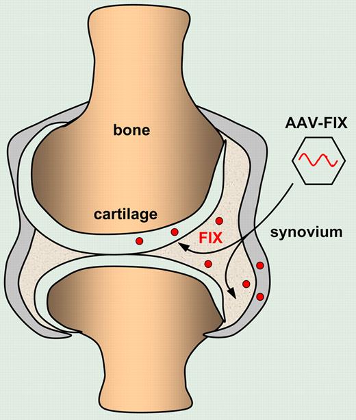 Intra-articular injection of AAV vectors encoding FIX results in local FIX production by transduced chondrocytes and synviocytes that protect against hemophilic synovitis.