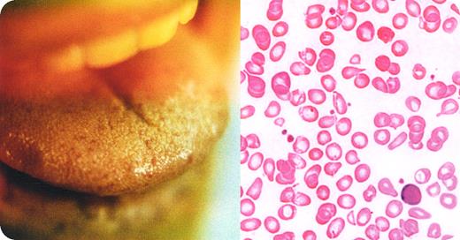 A 38-year-old man was seen by his physician for tiredness. He indicated that his stools were dark but that he occasionally took iron. The stool hemoccult affirmed the presence of blood. Laboratory work revealed a moderate anemia and mild reticulocytosis. The peripheral blood smear showed microcytosis and hypochromia. / The physician instructed the patient to take iron more frequently and to make a return visit. Two weeks later, there was no change in the hemoglobin. A referral was made for endoscopy. The gastroenterologist examined the patient and observed a few telangiectasias on the tips of the fingers and chest and numerous telangiectasias on the face and tongue (see photograph). When asked about the family history, the patient reported that his father and a few paternal aunts and uncles also had gastrointestinal bleeding. In addition, he noted that his teenaged daughter had telangiectasias. The gastroenterologist performed the endoscopic examination and found rare telangiectasias scattered throughout the upper gastrointestinal tract. / In this case, persistent iron deficiency was caused by continued gastrointestinal bleeding from hemorrhagic hereditary telangiectasia (HHT). This is an autosomal dominant disease with predominant mucocutaneous and visceral telangiectasia. HHT can be easily diagnosed when telangiectasias are found in combination with a family history of telangiectasias or bleeding. These vessel abnormalities can also be present in the lung and liver. Treatment options are limited except for local cauterization of acute bleeding sites and the use of vasopressin. More definitive therapy to prevent bleeding is limited but may include a trial of estrogen/progesterone hormones or anti-angiogenesis factors. Long-term iron therapy is usually needed for the anemia.