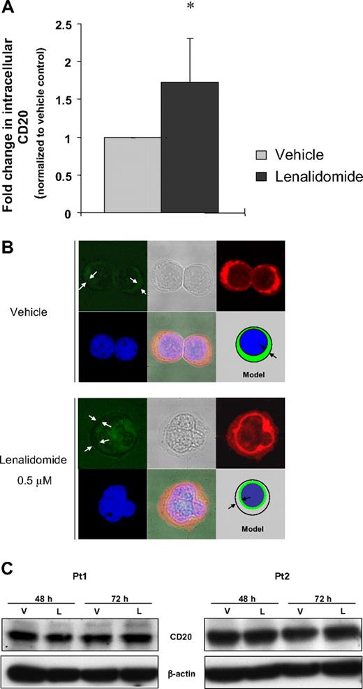 Figure 2. Lenalidomide induces CD20 internalization. (A) Cells were incubated with 50 μg/mL rituximab to block extracellular CD20, and then washed 3 times, fixed and stained with CD20-PE antibody, and analyzed by flow cytometer. In 6 of 8 patients, CD20 antigen down-regulation on the CLL cell surface is accompanied by increased intracellular fluorescence (P = .006). (B) Binding and internalization of anti-CD20 in CLL cells were examined by laser scanning confocal microscopy. CLL cells were incubated with lenalidomide for 48 hours at 37°C. Cells were washed, fixed, permeabilized, and stained for CD20 (green), concanavalin A (red), and DRAQ5 (blue). The images were examined by laser scanning confocal microscopy. (C) Lenalidomide treatment does not alter total level of CD20 protein. CD19+ cells were incubated with lenalidomide (0.5 μM) or vehicle control. CD20 total protein level was analyzed by Western blot after 48 and 72 hours of treatment. Results are shown from 2 representative patients who showed down-modulation of surface CD20 expression.