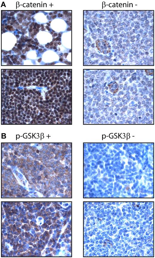 Figure 2. Expression of β-catenin in MCL tumors. (A) Immunohistochemistry using paraffin-embedded MCL tumors showed nuclear staining of β-catenin in a positive case (left panel). Only weak cytoplasmic staining was found in the tumor cells in a negative case, although endothelial cells showed intense cytoplasmic staining (right panel). (B) Immunohistochemistry using paraffin-embedded MCL tumors showed intense cytoplasmic staining of p-GSK3β in a positive case (left panel), but no appreciable staining in a negative case (right panel).