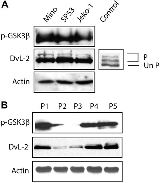 Figure 3. Activation status of the WNT pathway in MCL. (A) Western blot studies revealed the strong expression of p-GSK3β in all 3 MCL cell lines. In addition, DvL-2 was highly expressed. Importantly, the slowly migrating/phosphorylated forms of DvL-2 were detected in all 3 cell lines. Mouse stem cell lysates were used as positive controls for the phosphorylated forms of DvL proteins. P indicates the phosphorylated form of DvL-2 and UnP indicates the unphosphorylated form of DvL-2. (B) Western blot studies revealed the expression pattern of p-GSK3β in 5 MCL primary tumors. P1, P3, and P5 had a relatively high level of p-GSK3β, which was associated with relatively a high level of DvL-2 and the presence of its slowly migrating forms. In contrast, P2 and P3 had weak or undetectable p-GSK3β, which correlated with a weak DvL-2 expression.