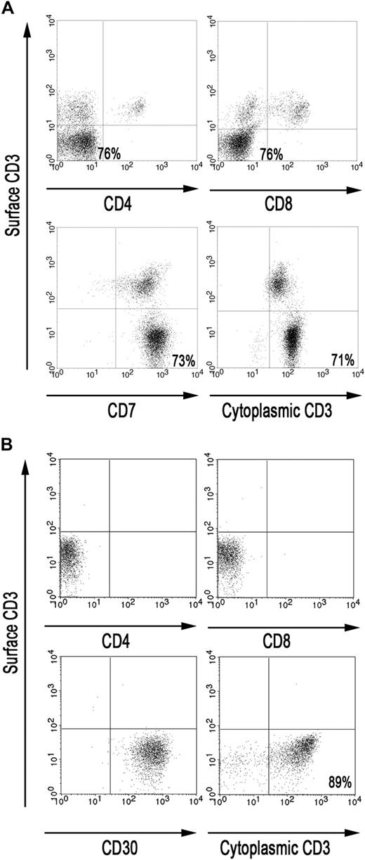 Figure 1. The majority of IELs in the small intestine of RCD II patient P1 are aberrant. (A) FACS analysis of IELs, directly isolated from duodenal biopsies from patient P1. (B) FACS analysis of RCD cell line P1, cultured from duodenal biopsies from patient P1. Analyses were performed on CD45bright cells within a live lymphocyte gate.
