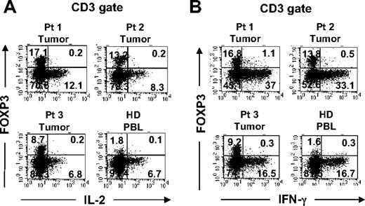 Figure 4. Functional comparison of FOXP3+CD4 T cells in tumors versus peripheral blood. Tumor digests from patients and peripheral blood samples from healthy donors were thawed and immediately stimulated with PMA/I for 6 to 8 hours in the presence of monensin. Cells were subsequently stained with anti-CD3, anti-CD8, and anti-FOXP3 mAb along with either (A) anti–IL-2 or (B) anti–IFN-γ mAbs. The dotplots were gated on CD3+ T cells. The numbers represent the percentages of T cells in each quadrant. These results are representative of multiple independent experiments using tumor digest samples from different patients (n = 26) and PBL samples from healthy donors (n = 3) and the same patients (n = 5; Figure 5).