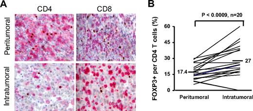 Figure 6. Enumerating FOXP3+ T cells within peritumoral and intratumoral sections using immunohistochemical analysis. Metastatic melanoma lesions from 20 patients were analyzed by immunhistochemistry to enumerate the number of FOXP3+ T cells in the intratumoral and peritumoral (stromal) areas in metastatic melanoma tumors. (A) CD4 (first column) and CD8 (second column) were visualized in pink and FOXP3 staining of nucleus was depicted in brown; ×40 magnification was used. (B) The percentage of FOXP3+CD4 T cells per total CD4 T-cell population in the intratumoral and peritumoral sections were calculated for each patient. The paired t test was used to compare between intratumoral and peritumoral sections.