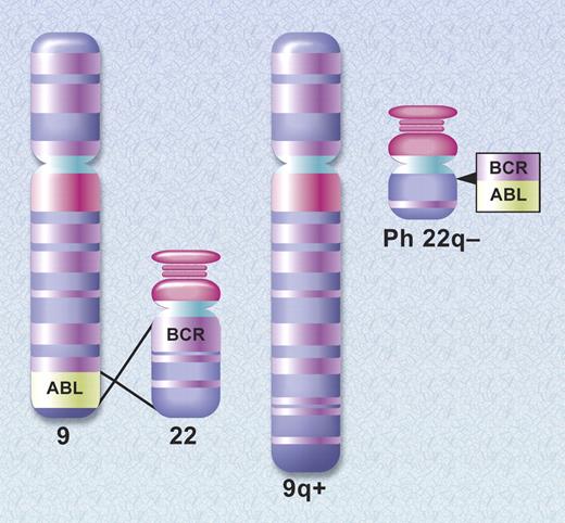 Figure 1. Schematic diagram of the translocation that creates the Philadelphia chromosome. The ABL and BCR genes reside on the long arms of chromosomes 9 and 22, respectively. As a result of the (9;22) translocation, a BCR-ABL gene is formed on the derivative chromosome 22 (Philadelphia chromosome). Illustration by A. Y. Chen.