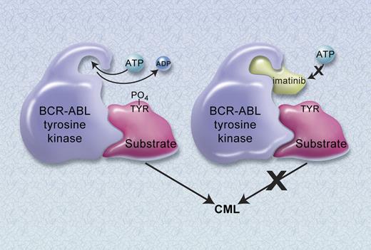 Figure 3. Mechanism of action of imatinib. (A) The constitutively active BCR-ABL tyrosine kinase functions by transferring phosphate from ATP to tyrosine residues on various substrates to cause excess proliferation of myeloid cells characteristic of CML. (B) Imatinib blocks the binding of ATP to the BCR-ABL tyrosine kinase, thus inhibiting kinase activity. Illustration by A. Y. Chen.