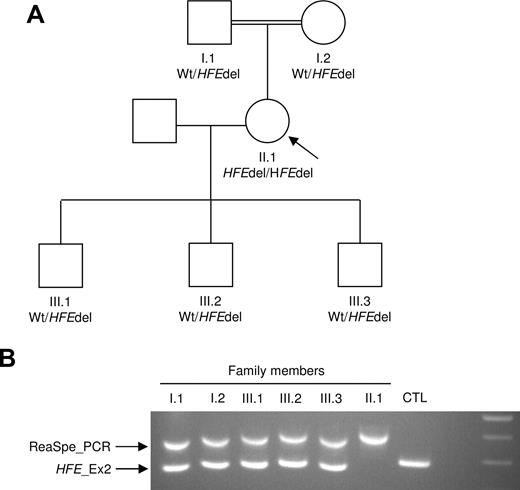 Figure 2. Family study and rearrangement specific PCR design. (A) Family tree. The index case is indicated by ↖. Wt indicates wild-type allele; HFEdel, HFE knocked-down allele. (B) Rearrangement-specific PCR of the patient and her relatives. Primers were designed to amplify across the junctions and give a PCR product of 499 bp (ReaSpe_PCR). Also, a PCR was designed to amplify the wild-type sequence; this targets the HFE exon 2 (HFE_Ex2) and produces a 377 bp DNA fragment. Primer pairs were mixed to create a duplex PCR assay.