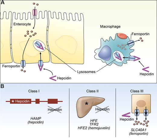 Figure 2. Hepcidin and hemochromatosis. (A) The activity of hepcidin is depicted, showing ferroportin as a target both on enterocytes and macrophages. Hepcidin binds to ferroportin triggering its internalization and lysosomal degradation. (B) Three classes of hemochromatosis disorders all affect the hepcidin/ferroportin regulatory axis: Class I, defects in the hepcidin gene (HAMP) preventing production of functional hepcidin; Class II, defects in HFE, TFR2, or HFE2 genes preventing normal hepatic regulation of hepcidin expression; Class III, defects in ferroportin preventing normal regulation by hepcidin. Illustration by Kenneth Probst.