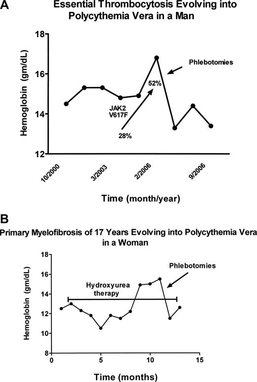 Figure 1. Evolution of essential thrombocytosis and primary myelofibrosis into polycythemia vera. (A) Erythrocytosis developing in a 60-year-old man with essential thrombocytosis 6 years after diagnosis. The increase in the JAK2 V617F neutrophil allelic burden with time is also shown. The hemoglobin (Hgb) level was reduced by phlebotomy. (B) Erythrocytosis developing in a 70-year-old woman with classic PMF of 17 years' duration, while taking hydroxyurea to control splenic enlargement (bracketed line). The hemoglobin (Hgb) level was reduced by phlebotomy.