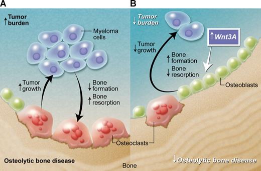 Effect of Wnt3A in the bone microenvironment in multiple myeloma. (A) Myeloma cells promote the development of the associated bone disease, and the bone disease promotes tumor growth and survival, resulting in a vicious cycle of increased tumor burden and increased osteolytic bone disease. (B) Wnt3A enhances Wnt signaling in the bone marrow microenvironment. This has no direct effect on myeloma-cell growth, but acts to increase bone formation and decrease bone resorption. This inhibits myeloma bone disease and, consequently, indirectly reduces tumor burden in bone. Professional illustration by Alice Chen.