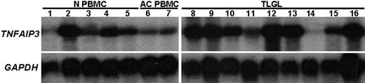 Figure 4. Differential expression of TNFAIP3 (A20) mRNA in leukemic LGLs compared with activated normal PBMCs. Total RNA (10 μg) from 9 LGL patients and from 5 healthy individuals was analyzed by Northern blot hybridization. The blot was probed with 800-bp fragment of TNFAIP3 or housekeeping gene (GAPDH). Northern blot analysis shows that TNFAIP3 is constitutively expressed in naive normal PBMCs (N PBMCs, lanes 1-5) and that the expression was down-regulated following PHA+IL-2 activation of normal PBMCs (AC PBMCs, lanes 6-7). In contrast, the expression of TNFAIP3 gene transcripts was much higher in RNA from LGL leukemia patients (TLGLs, lanes 8-16) compared with activated normal PBMCs. (White spaces have been inserted to indicate realigned gel lanes.)