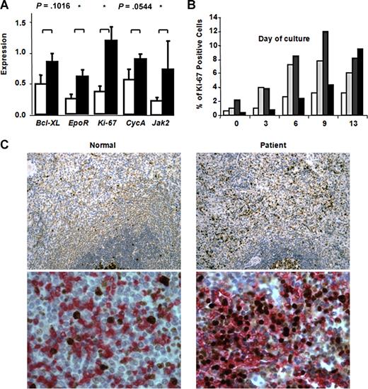 Figure 6. Increased number of proliferating erythroid cells in human thalassemic specimens. (A) At the end of the 2-phase liquid culture, the absolute expression of Bcl-XL, EpoR, Ki-67, CycA, and Jak2 mRNA relative to 14S ribosomal control RNA was quantified in 11 patients (black) and 6 healthy controls (white). An unpaired t test was used for statistical analysis. Benzidine staining was used to evaluate the level of erythroid differentiation. Both the amounts of β-globin mRNAs and those of cell cycle–related genes were quantified by quantitative polymerase chain reaction assay. We also performed highperformance liquid chromatography (HPLC) to determine variations in the percentages and absolute amounts of adult Hb in treated and nontreated samples (not shown). Error bars represent SD. (B) Time dependence of proliferating erythroid cells from 3 thalassemic patients (light gray, gray, and black) and one control subject (white). Aliquots of cells after various days of culture (second phase), corresponding to different stages of erythroid differentiation, were collected, cytospun, and stained for the proliferative marker Ki-67. Thalassemic patients showed an increased number of proliferating cells. More than 300 cells were counted to obtain the percentage of Ki-67–positive cells in each aliquot. (C) Spleen sections from a healthy subject (traumatic rupture) and a thalassemic patient (transfused thalassemia intermedia) who underwent splenectomy. Top panels: Ki-67 staining (brown; magnification, 100×). Bottom panels: Ki-67 (brown) and a mixture of glycophorin C and alpha-1-spectrin (red; magnification, 400×). A Plan Fluor 10×/0.30 numeric aperture objective and a Plan Fluor 40×/0.75 numeric aperture objective were used, along with the same microscope, camera, and software as in Figure 1.