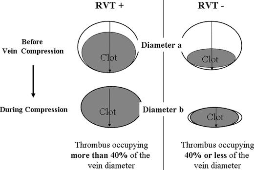 Figure 1. Evaluation of residual vein thrombosis. RVT calculation = vein diameter during compression (diameter b) × 100/vein diameter before compression (diameter a). RVT indicates residual vein thrombosis.