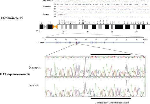 Figure 1. Chromosome 13q segmental UPD acquired at relapse in patient 4, showing a change from heterozygosity (alleles AB in red) to homozygosity (alleles AA or BB in blue). An identical mutated sequence of FLT3 ITD is shown in the region of UPD at q12.2 at diagnosis and relapse, with loss of heterozygosity.